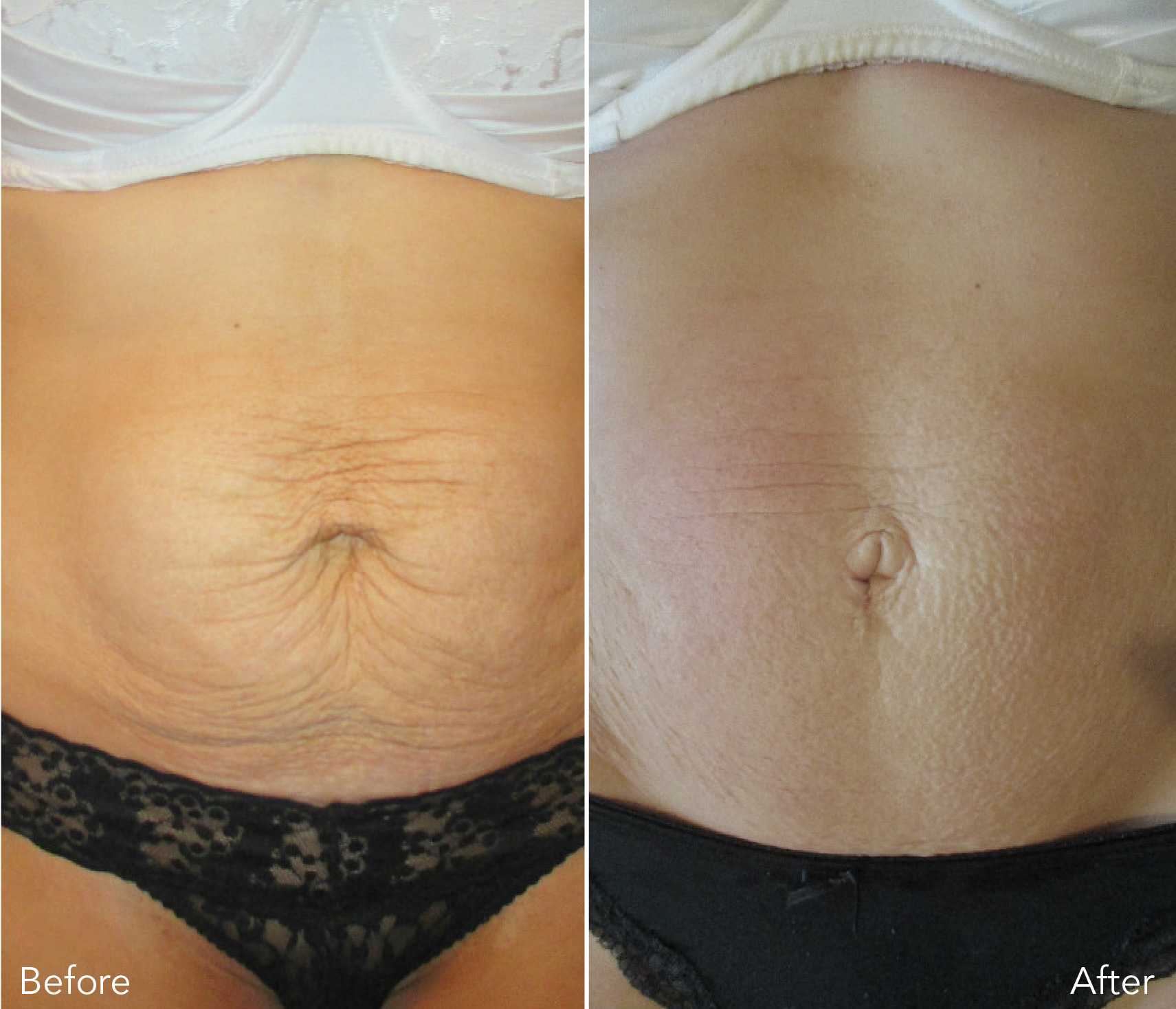 Body sculpting & skin tightenting before and after